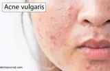 Acne vulgaris