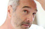 Alopecie - diagnostika a terapie