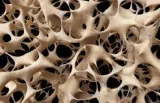 Diagnostika a léčba osteoporózy (1)