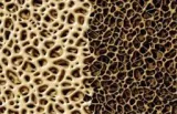 Diagnostika a léčba osteoporózy (2)